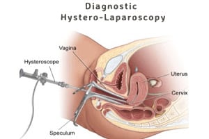 family planning laparoscopic operation cost